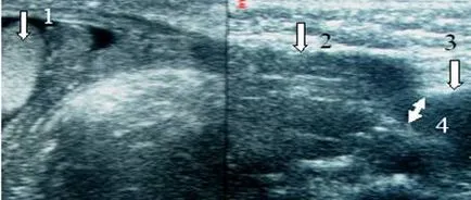 Ultrasunete a canalului inghinal, portalul radiologi