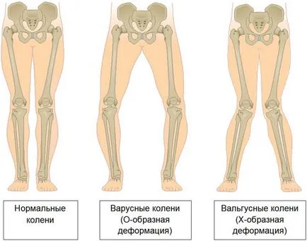 Valgus и Varus деформация на колянната става лечение и профилактика