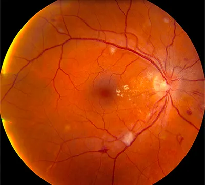 Angiopathy a retina magas vérnyomásos típusú - hipertóniás angiopátia