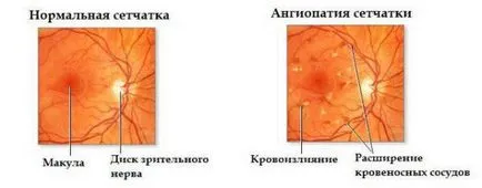 Angiopatie a retinei în ochii simptomele copilului și tratamentul codului ICD-10, tip hipertensivi, ambele,