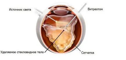 Angiopatie a retinei în ochii simptomele copilului și tratamentul codului ICD-10, tip hipertensivi, ambele,