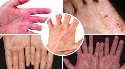 eczeme alergice pe mâini - cauze, simptome și tratament
