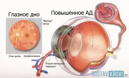 ретинални съдови ангиопатия очите Какво има, дете, възрастен, симптоми, лечение