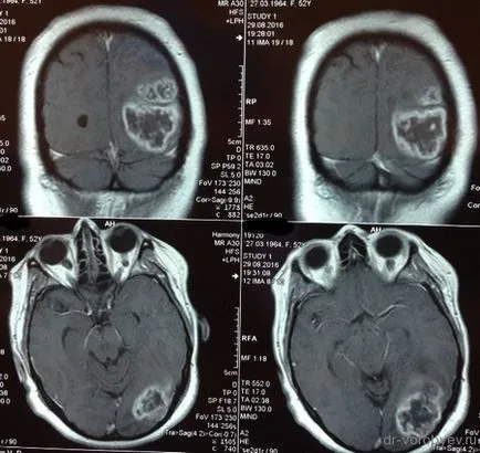 astrocitom anaplazic, neurochirurgie