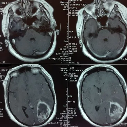 astrocitom anaplazic, neurochirurgie