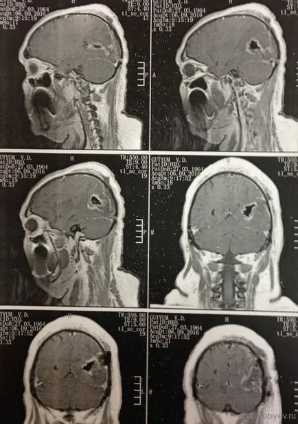 astrocitom anaplazic, neurochirurgie