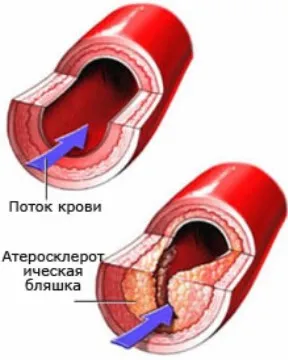 Атеросклерозата как да се избегнат сериозни проблеми