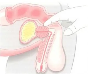 подготовка биопсия на простатата и провеждане на процедури