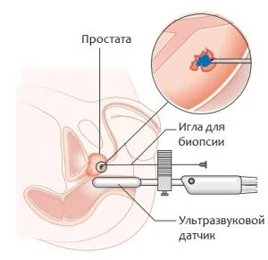 подготовка биопсия на простатата и провеждане на процедури