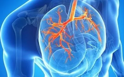 Bronșiectazie pulmonar cauze, simptome, diagnostic și tratament
