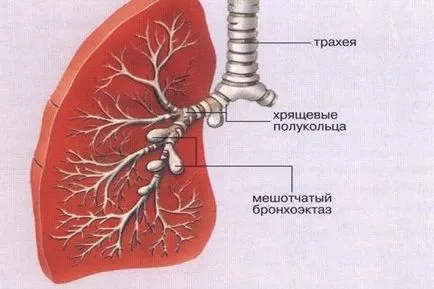 Bronșiectazie pulmonar cauze, simptome, diagnostic și tratament