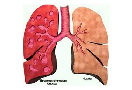 Бронхиектазиите белия дроб причини, симптоми, диагностика и лечение