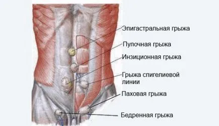 rețete și instrumente de medicamente pentru lechegnii hernie inghinala - să fie sănătos