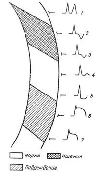 Elektrokardiogram aneurizma a szív - az elektrokardiogramon szívkoszorúér-betegség -