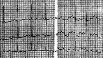 Elektrokardiogram aneurizma a szív - az elektrokardiogramon szívkoszorúér-betegség -