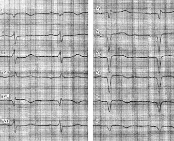 Elektrokardiogram aneurizma a szív - az elektrokardiogramon szívkoszorúér-betegség -