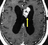 Ependimomul cerebral - cauze, simptome, diagnostic și tratament