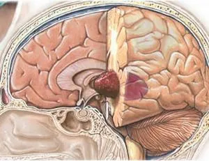 Ependimoma agy és a gerincvelő (anaplasticus, és mások), mint egy élvezet, az előrejelzés