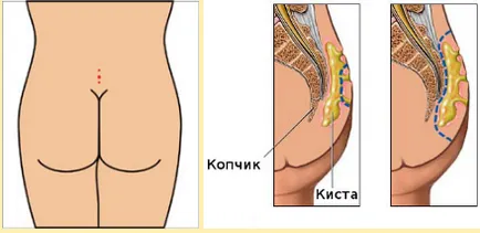 Epitelială coccigiană muta - tratament de la Moscova