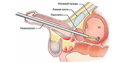 simptome fibroza prostatei, tratament, prognostic