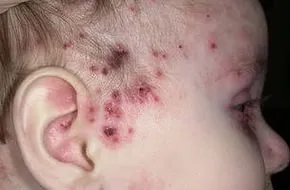 Herpetiformă (HSV) sarcom eczema