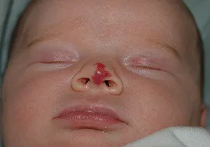 Хемангиоми при новородени снимка и клиничните прояви на болестта