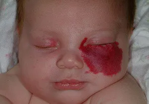 Хемангиоми при новородени снимка и клиничните прояви на болестта