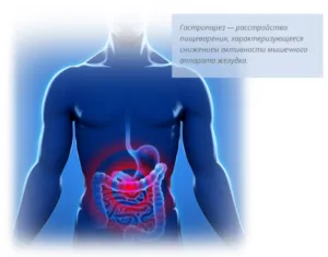 Гастропарезата причината за заболяването, симптомите и лечението