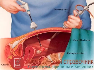 Hidrosalpinx pe stânga și dreapta - simptome, semne, fara chirurgie