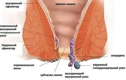 Hemoroizi, tratamentul hemoroizilor la domiciliu rapid remedii populare