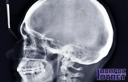 Hiperostoză a osului frontal, care este, fotografii, prevenire, simptome, tratament