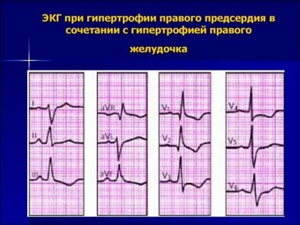 Hypertrophia a jobb pitvar EKG jelei kamrai hipertrófia s típus