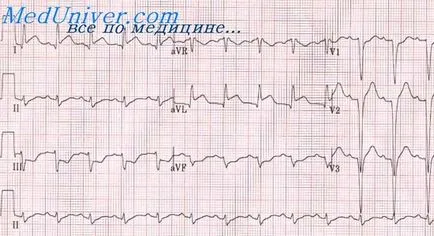 miocardic septal profundă