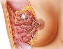 рак на гърдата инфилтрационна (инфилтриращи карцином) прогноза, симптомите и лечението
