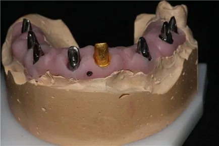 Използването галванично капачки в протезирането върху импланти - стоматологична - новини