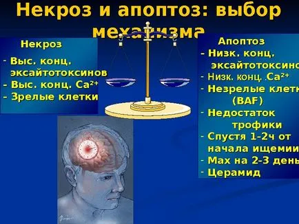 Исхемичен инсулт изпълнени член