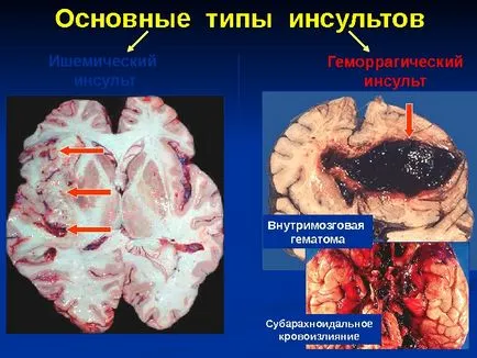 Исхемичен инсулт изпълнени член