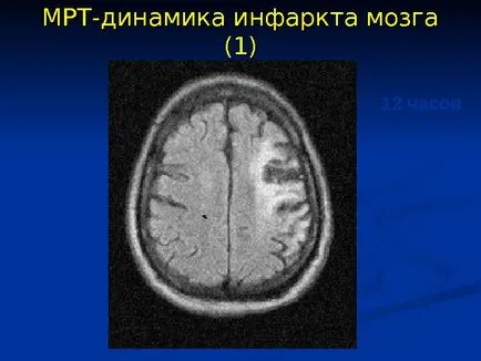 Исхемичен инсулт изпълнени член