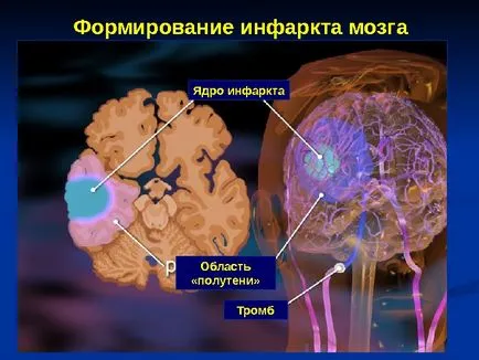 Исхемичен инсулт изпълнени член