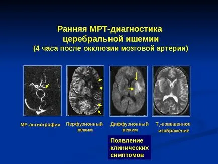 Исхемичен инсулт изпълнени член