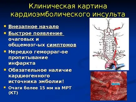 Исхемичен инсулт изпълнени член