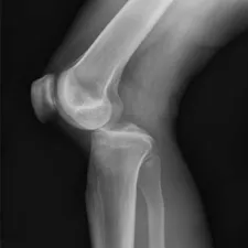 Разместване на колянната става симптоми, лечението с, последствията и рехабилитация