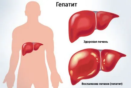Az alkohol hatásai és a dohányzás hepatitisz