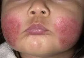 Cum sa scapi de probleme ale pielii, în dermatita alergică Dr. Komarovsky