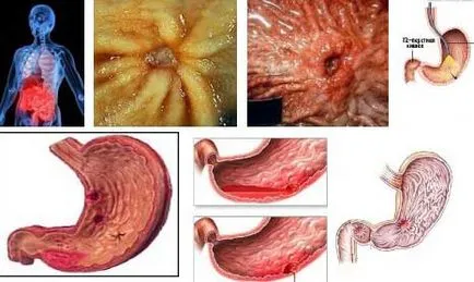 Cum de a trata ulcerul gastric și ulcer duodenal