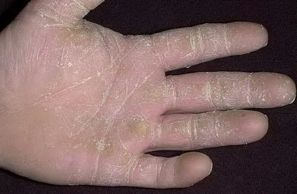 Как болестта на кожата на ръцете