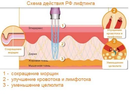 Как да провеждат RF-лифтинг у дома - на радио вълните и радиочестотни процедури