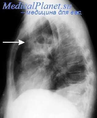 Tratamentul chirurgical al abces pulmonar acut