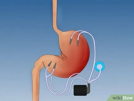 Hogyan lehet gyógyítani a diabéteszes gastroparesis