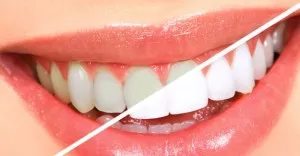 Ceruza fogfehérítés fényes fehér fogak, fogfehérítés tollat, láthatóságának és hatékonyságának